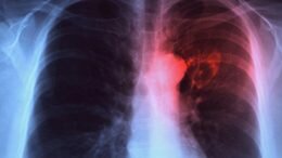 Tuberculosis lung disease